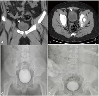 Case Report: Intravesical and extravesical urachal cyst in children with lower abdominal pain and hematuria